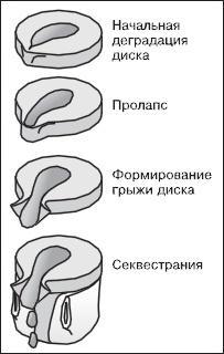 Остеохондроз. Как победить боль