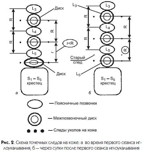 Новый взгляд на остеохондроз. Причины и лечение