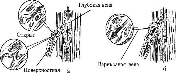 Варикозное расширение вен. Лечение традиционными и нетрадиционными методами