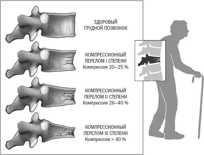 Йога при остеопорозе