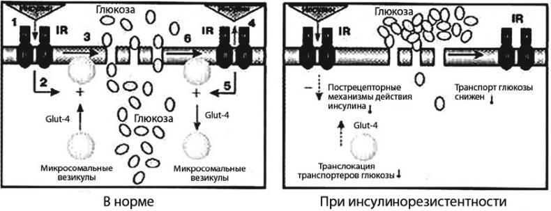 Сахарный диабет